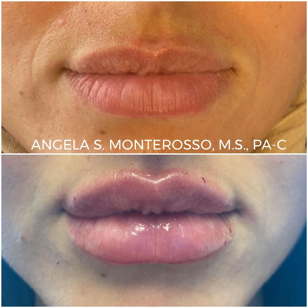 Lip Augmentation