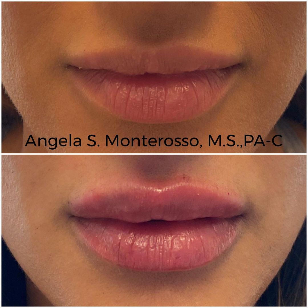 Lip Augmentation