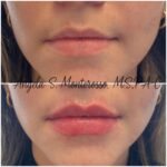 Lip Augmentation