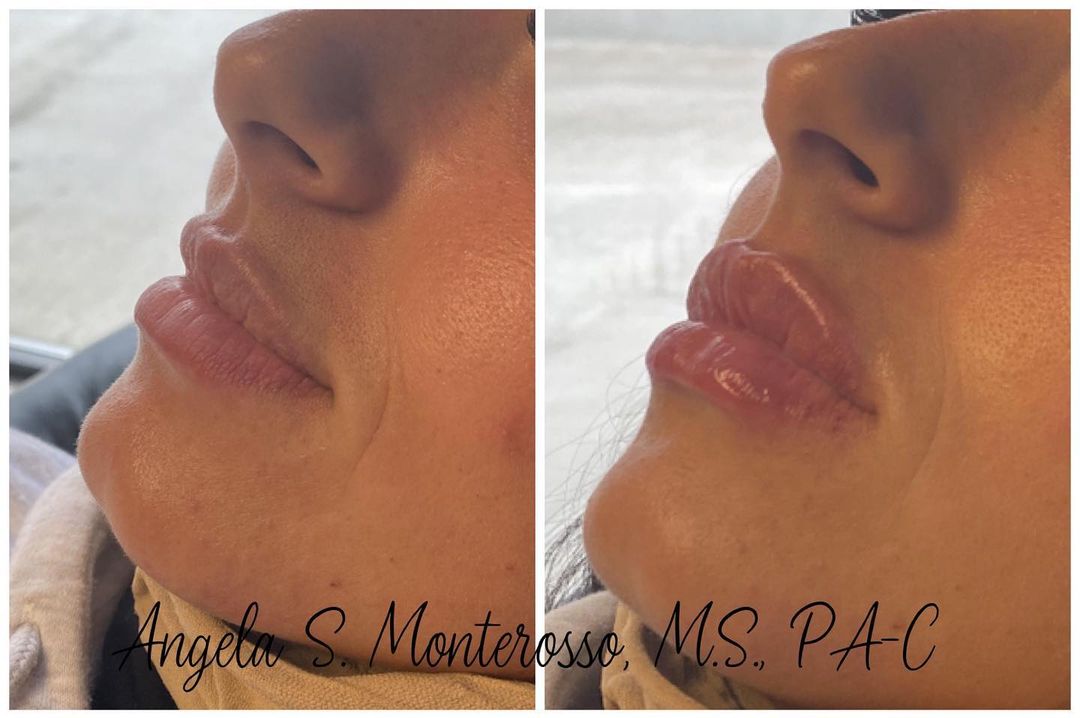 Lip Augmentation