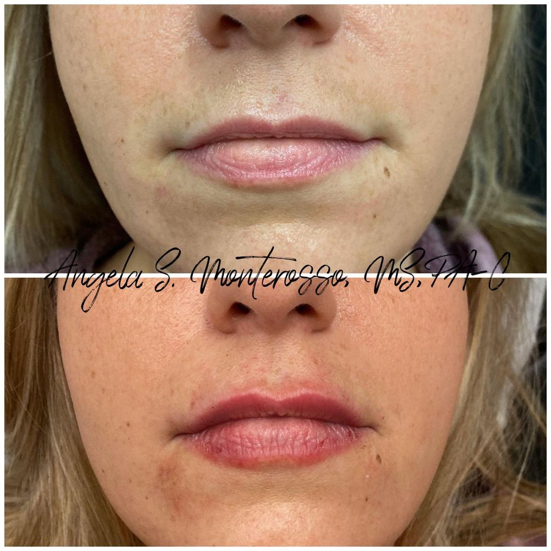 Lip Augmentation