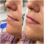 Lip Augmentation