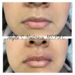 Lip Augmentation