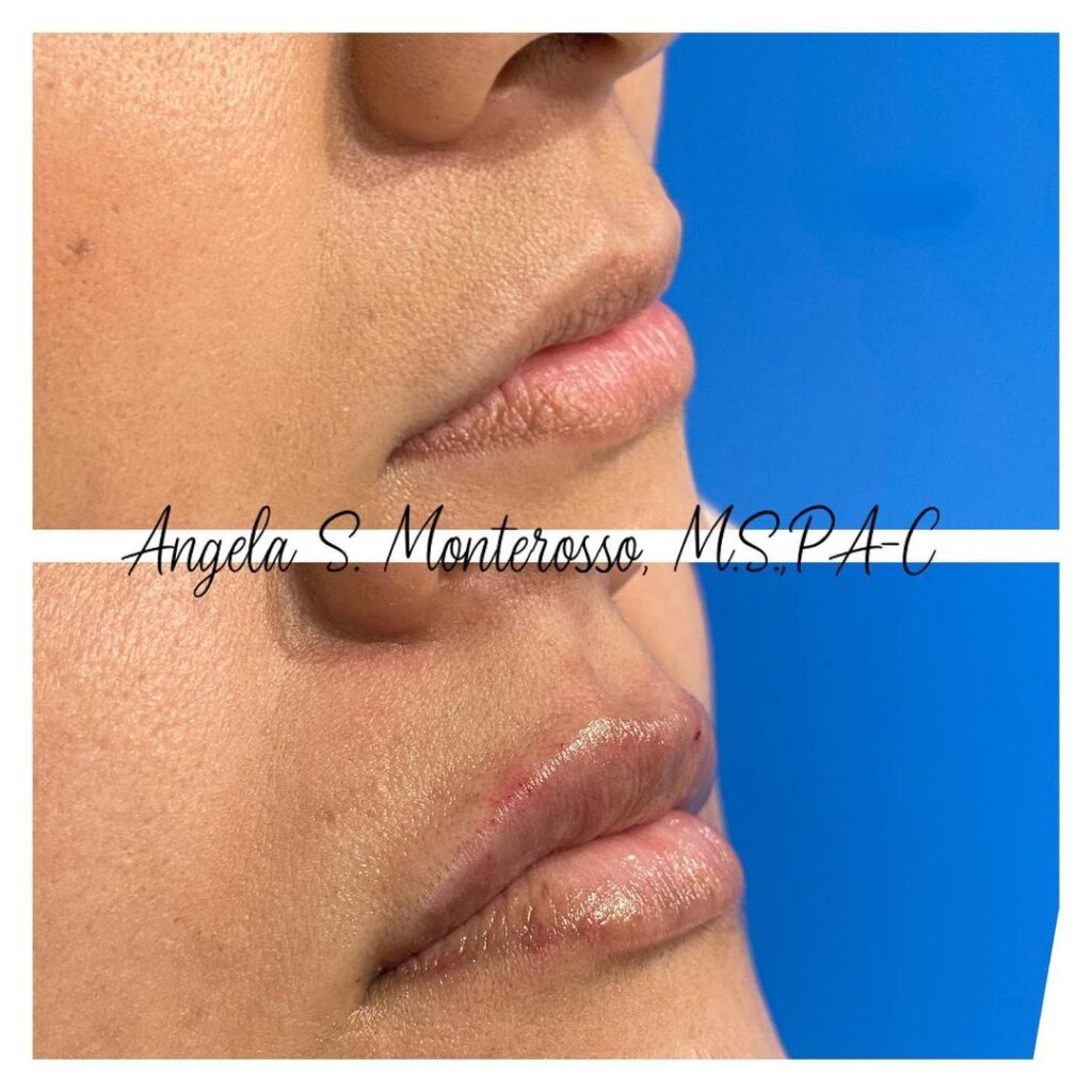 Lip Augmentation