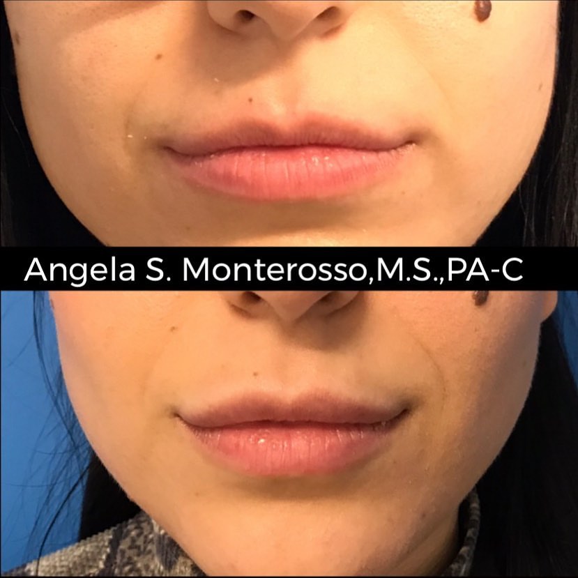 Lip Augmentation