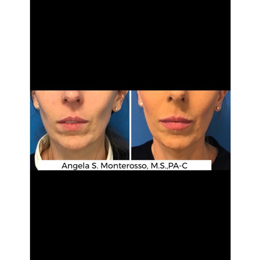 Lip Augmentation