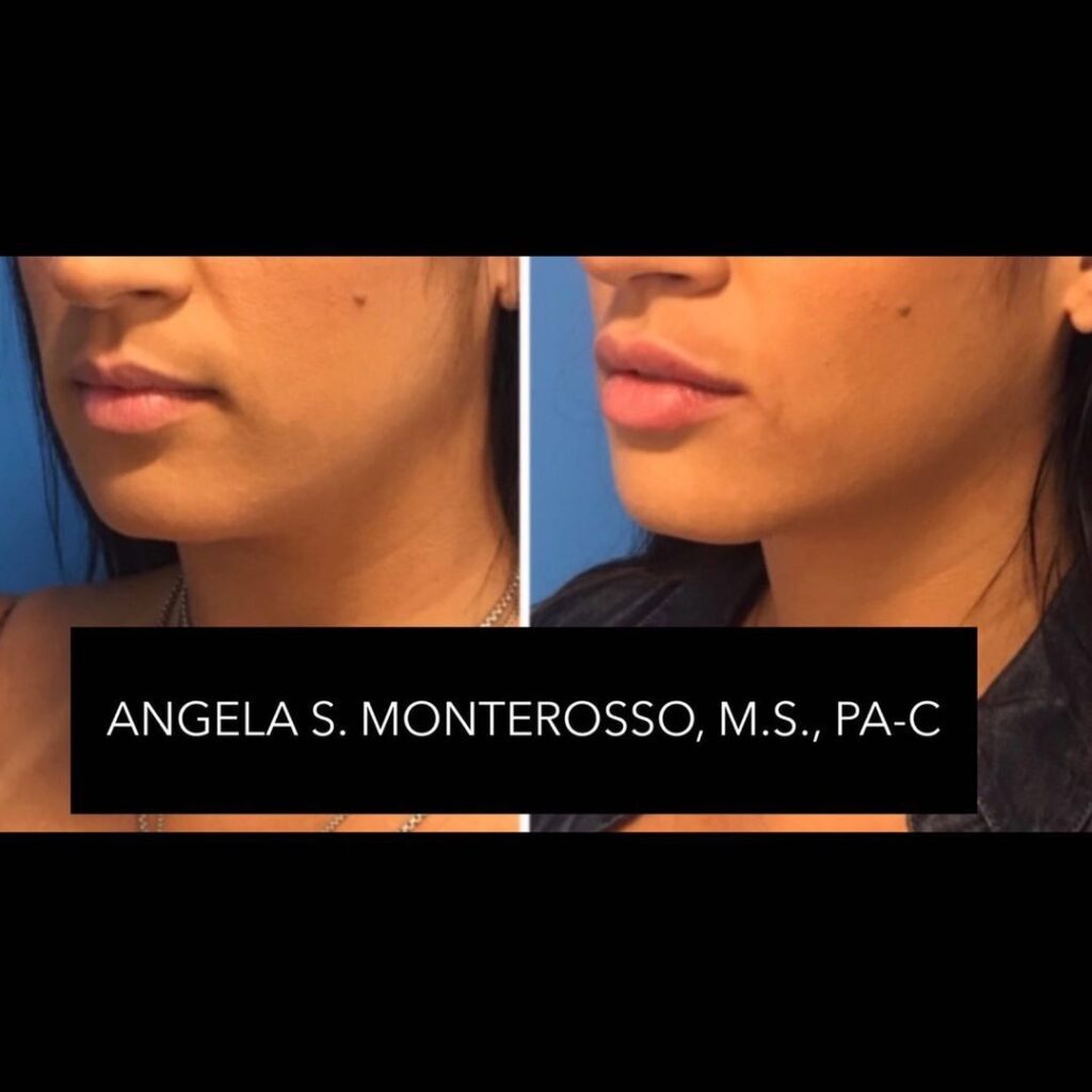 Lip Augmentation