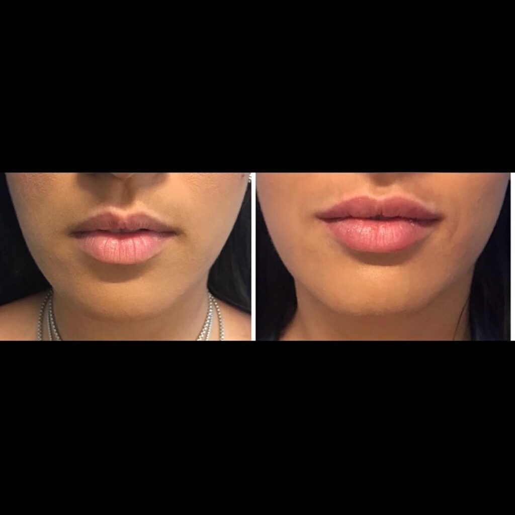 Lip Augmentation