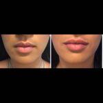 Lip Augmentation