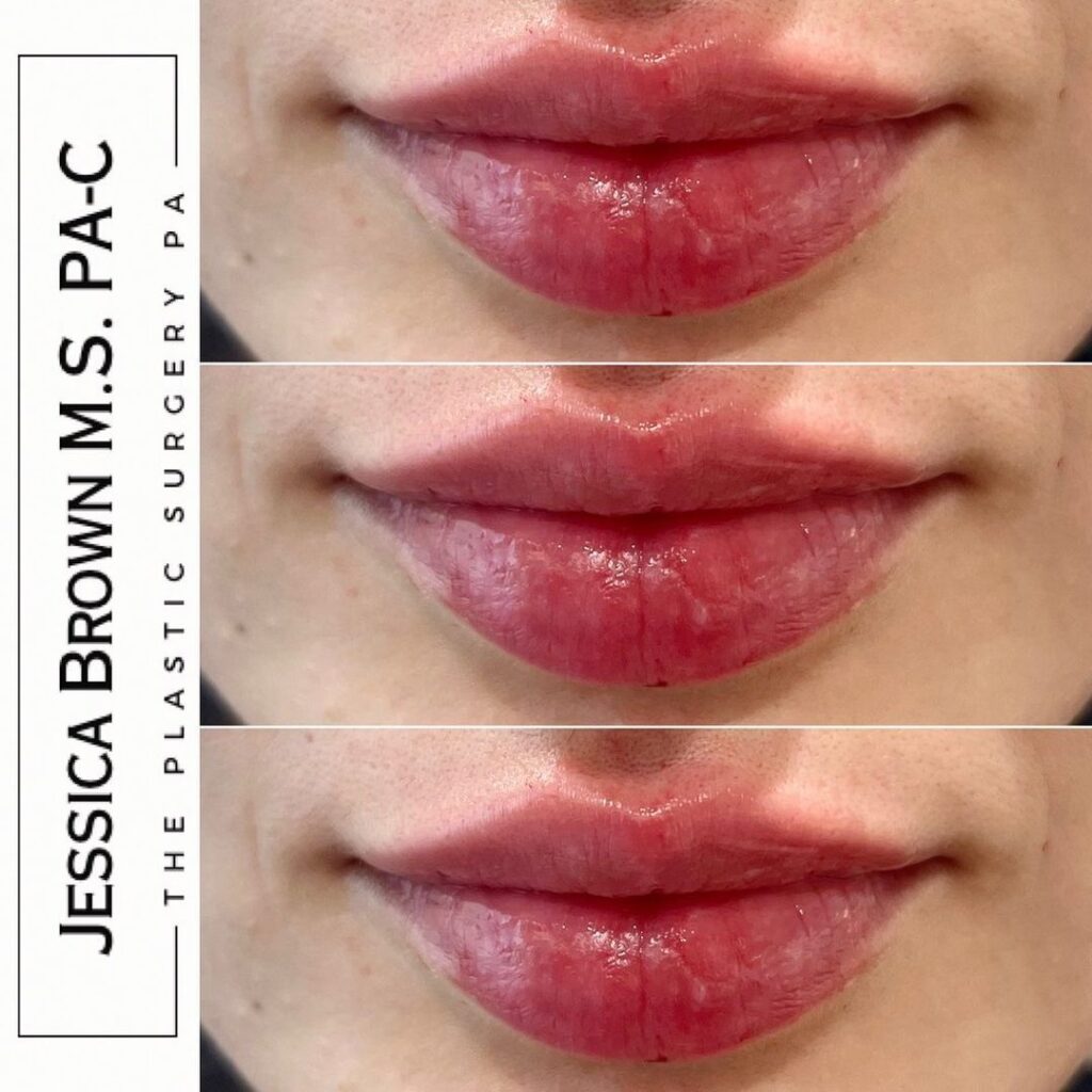 Lip Augmentation