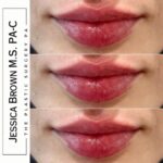 Lip Augmentation