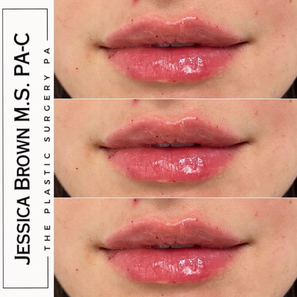 Lip Augmentation