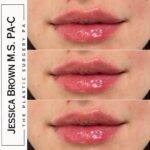 Lip Augmentation