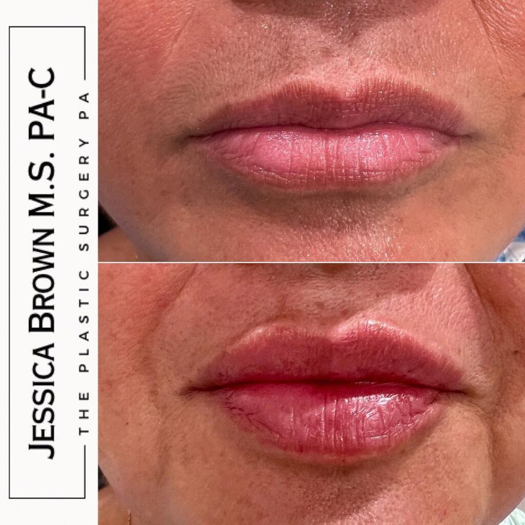 Lip Augmentation