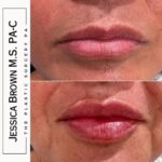 Lip Augmentation