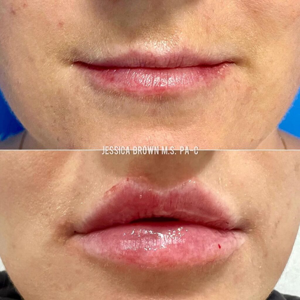 Lip Augmentation