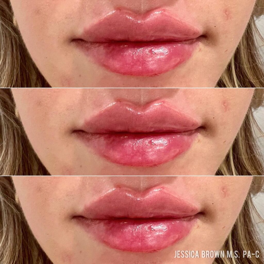 Lip Augmentation