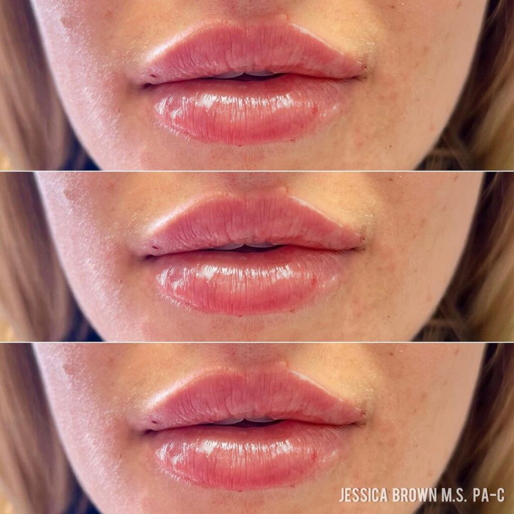 Lip Augmentation