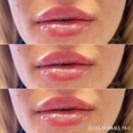 Lip Augmentation