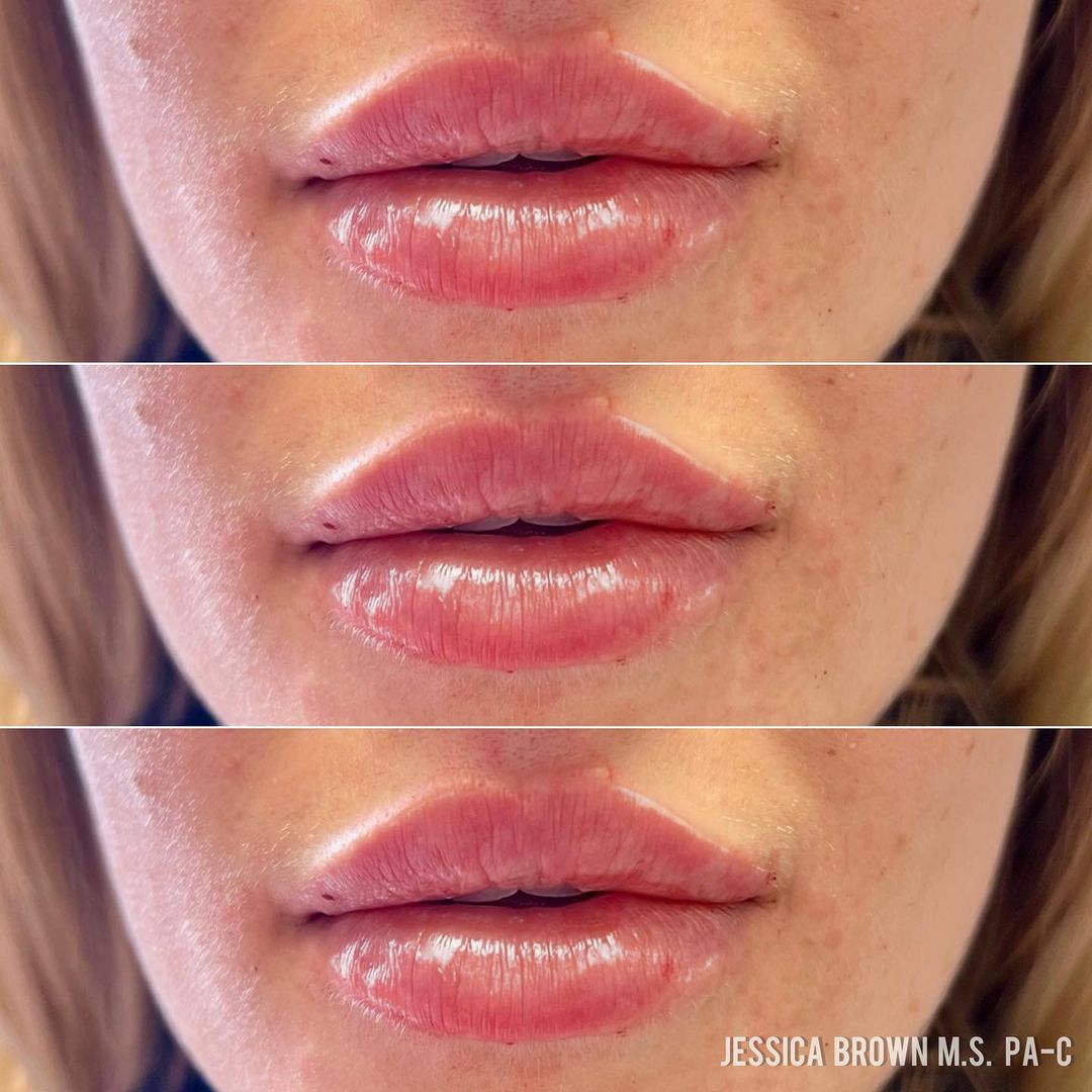 Lip Augmentation