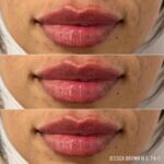 Lip Augmentation