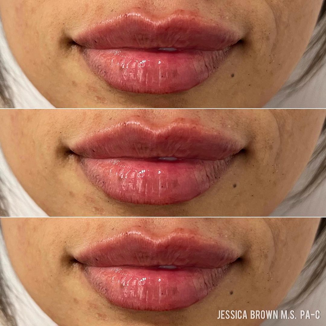 Lip Augmentation