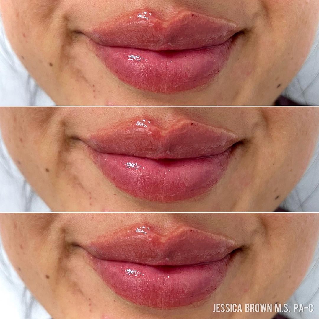 Lip Augmentation