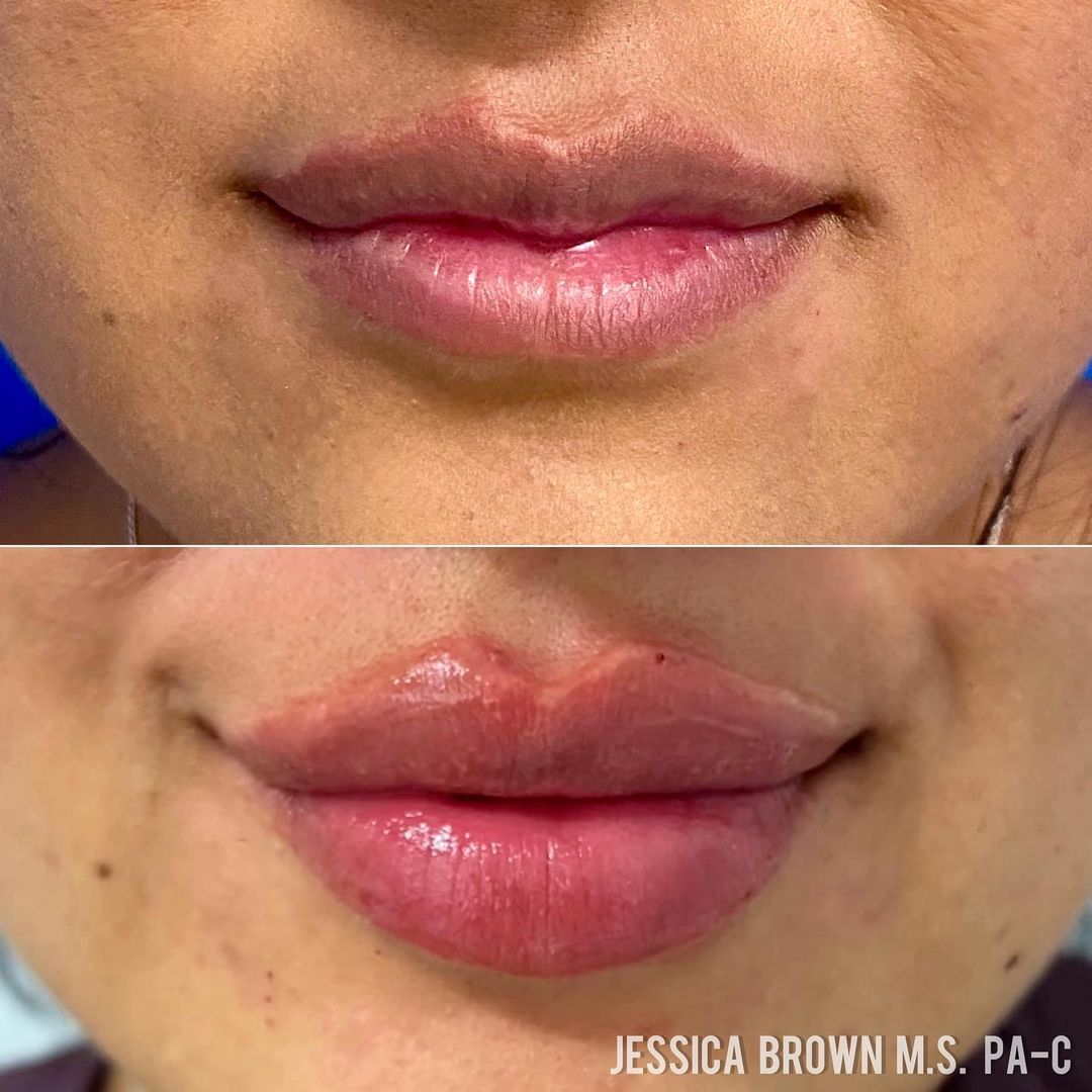 Lip Augmentation