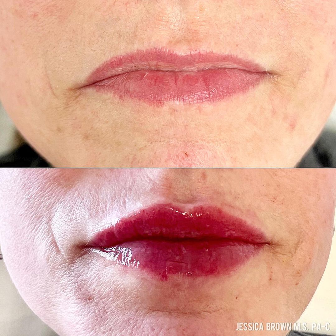 Lip Augmentation