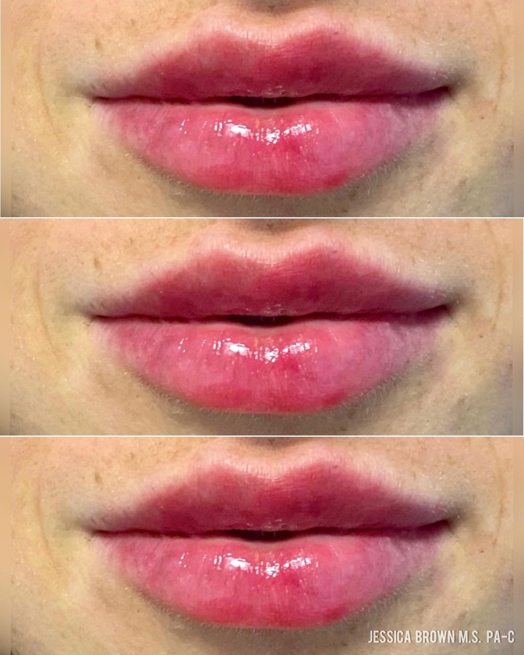 Lip Augmentation
