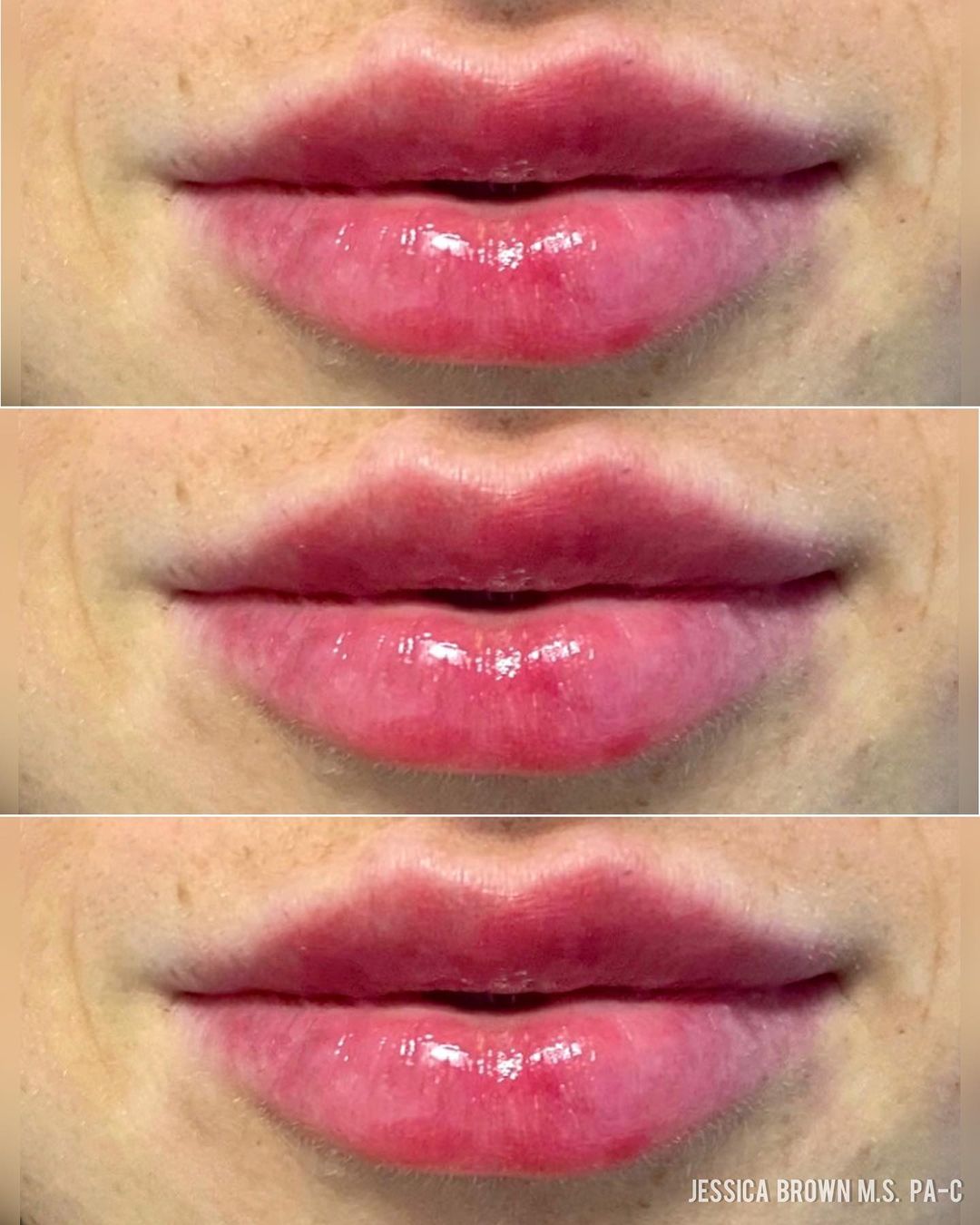 Lip Augmentation