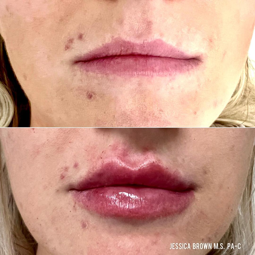 Lip Augmentation