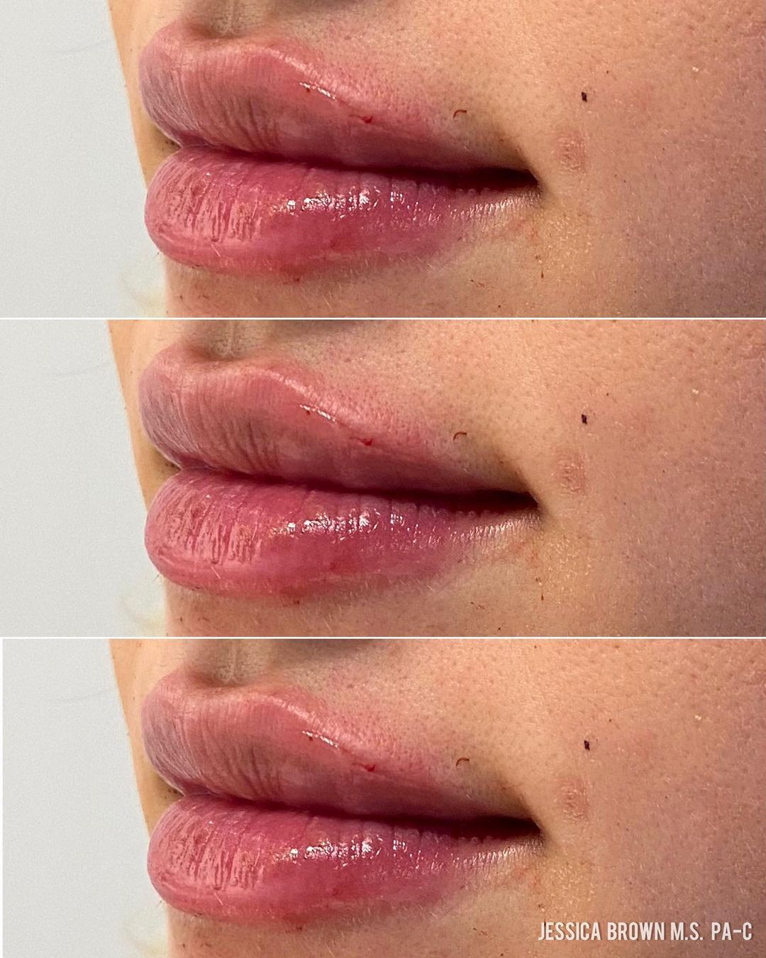 Lip Augmentation