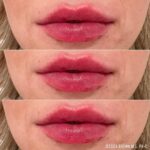 Lip Augmentation