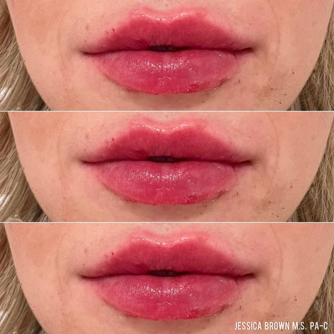 Lip Augmentation