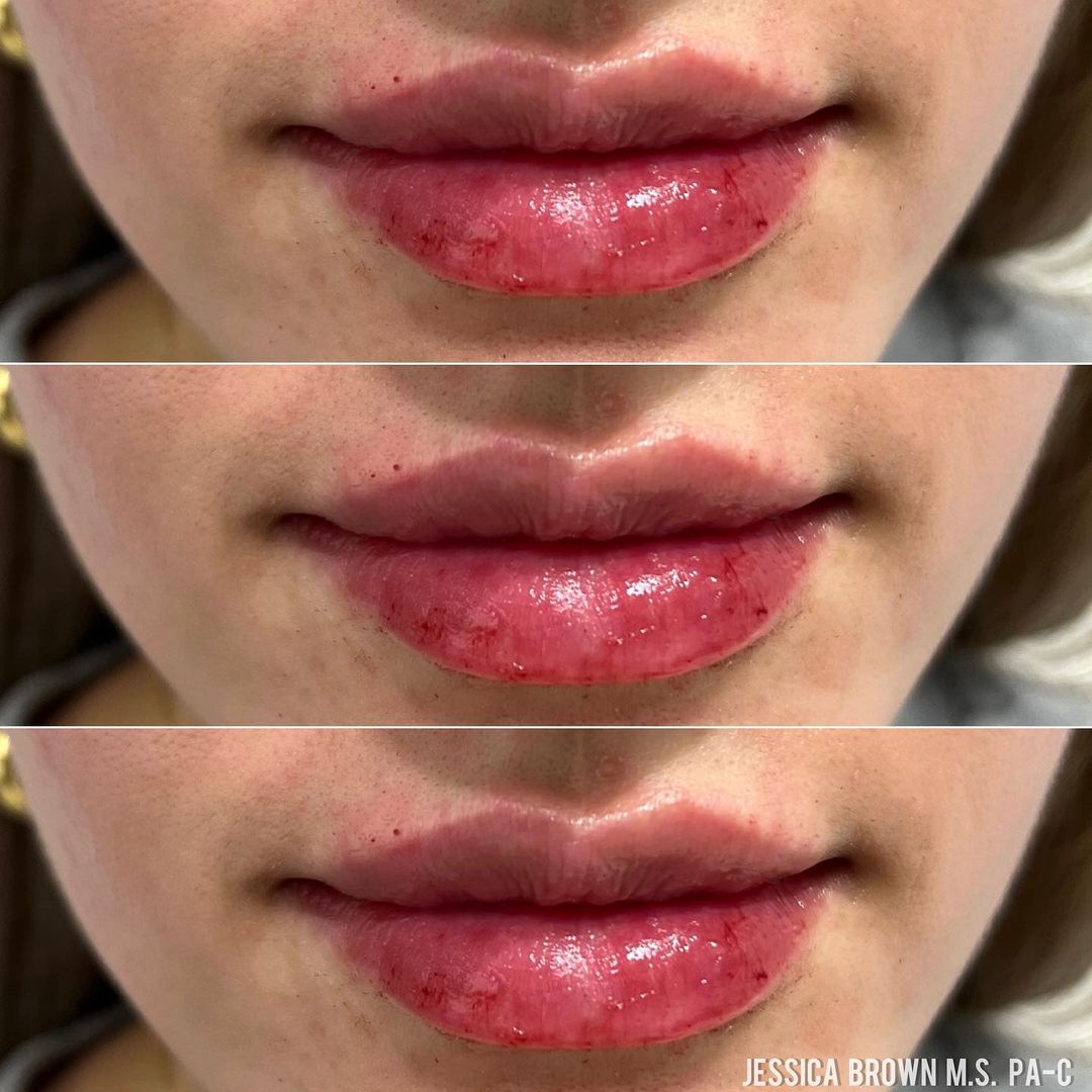 Lip Augmentation