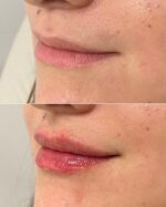 Lip Augmentation