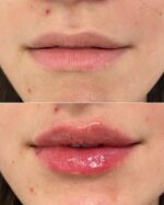 Lip Augmentation
