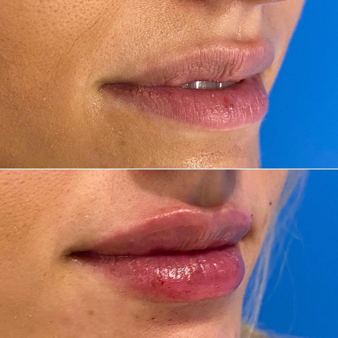 Lip Augmentation