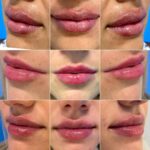 Lip Augmentation