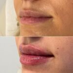 Lip Augmentation