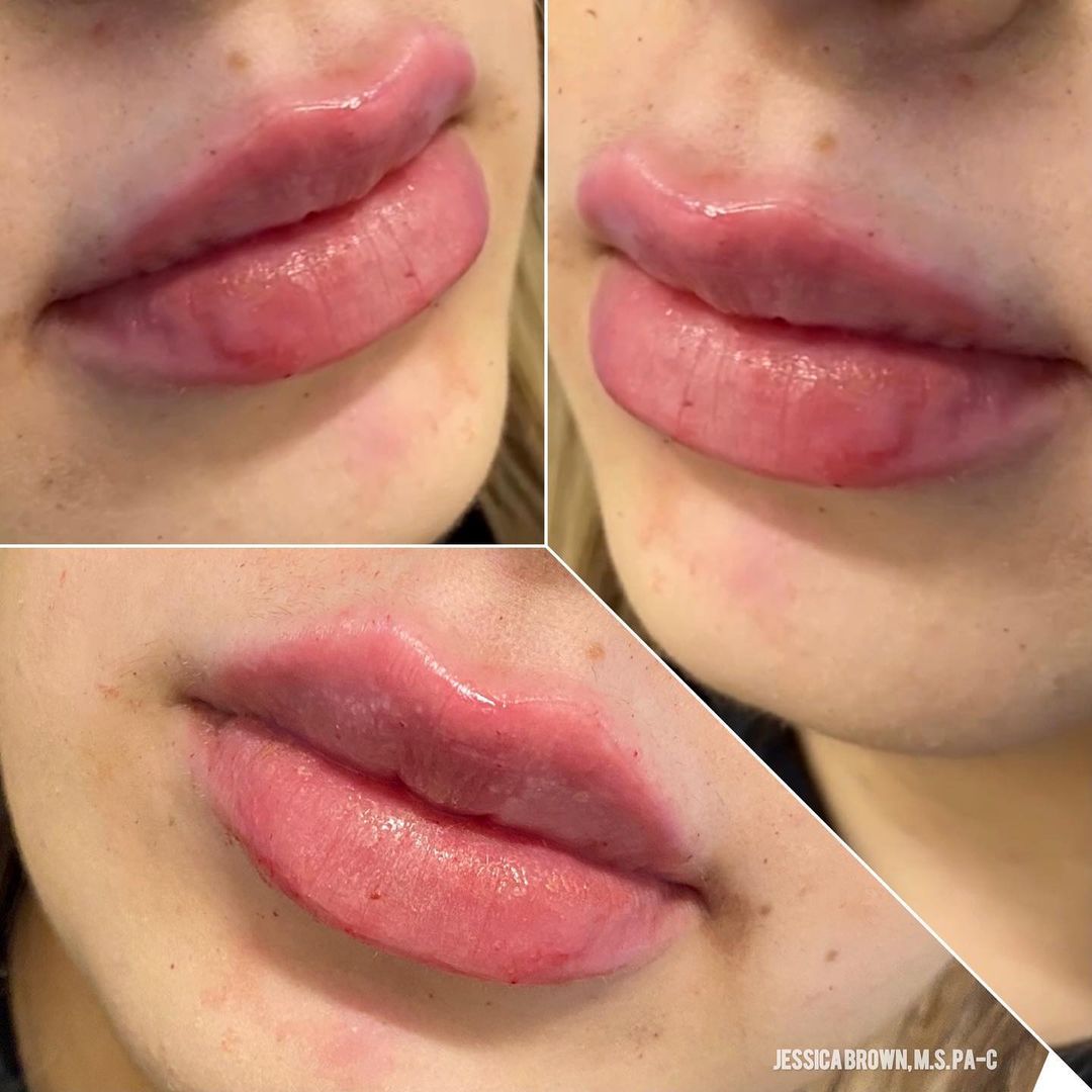 Lip Augmentation