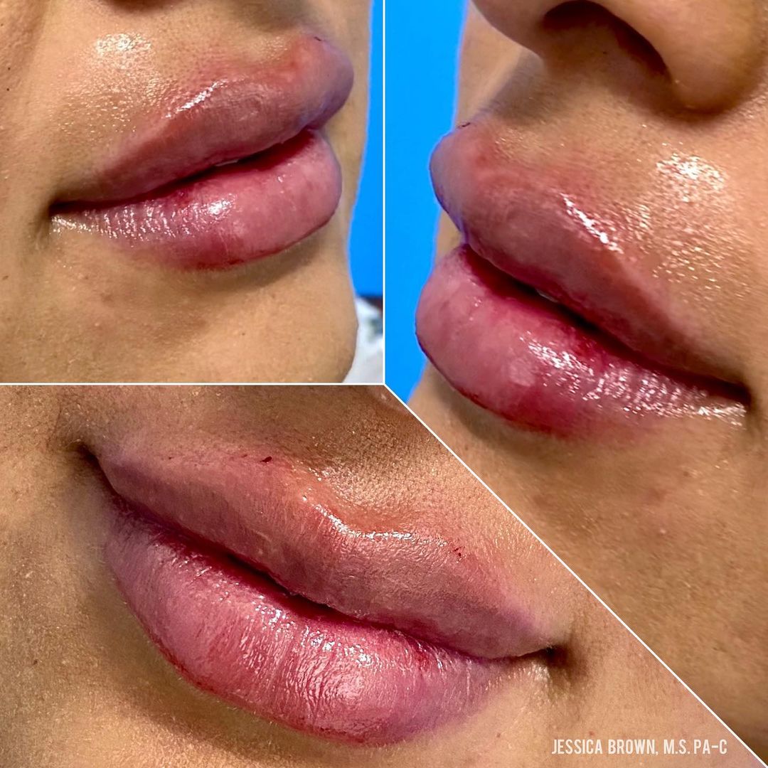 Lip Augmentation