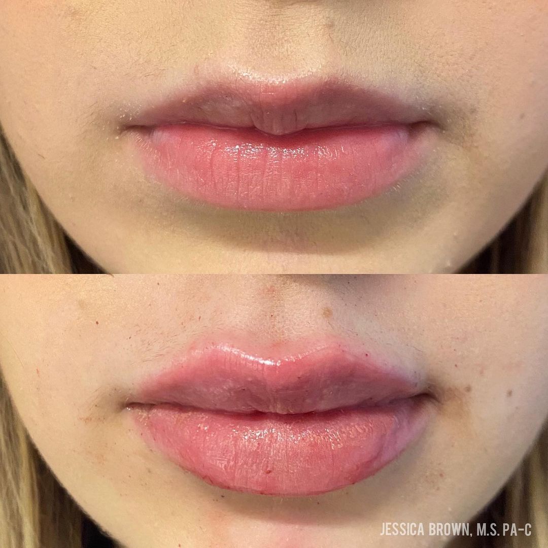 Lip Augmentation