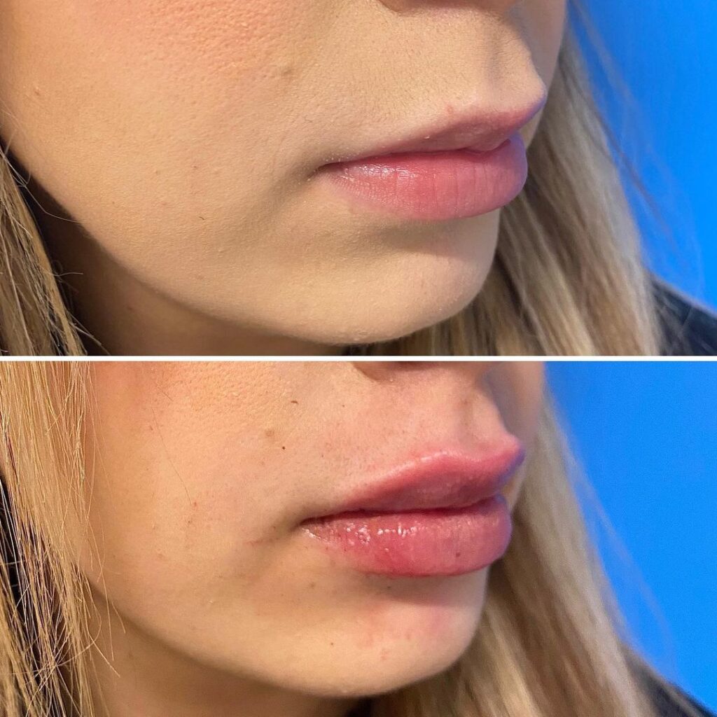 Lip Augmentation