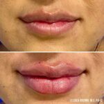 Lip Augmentation