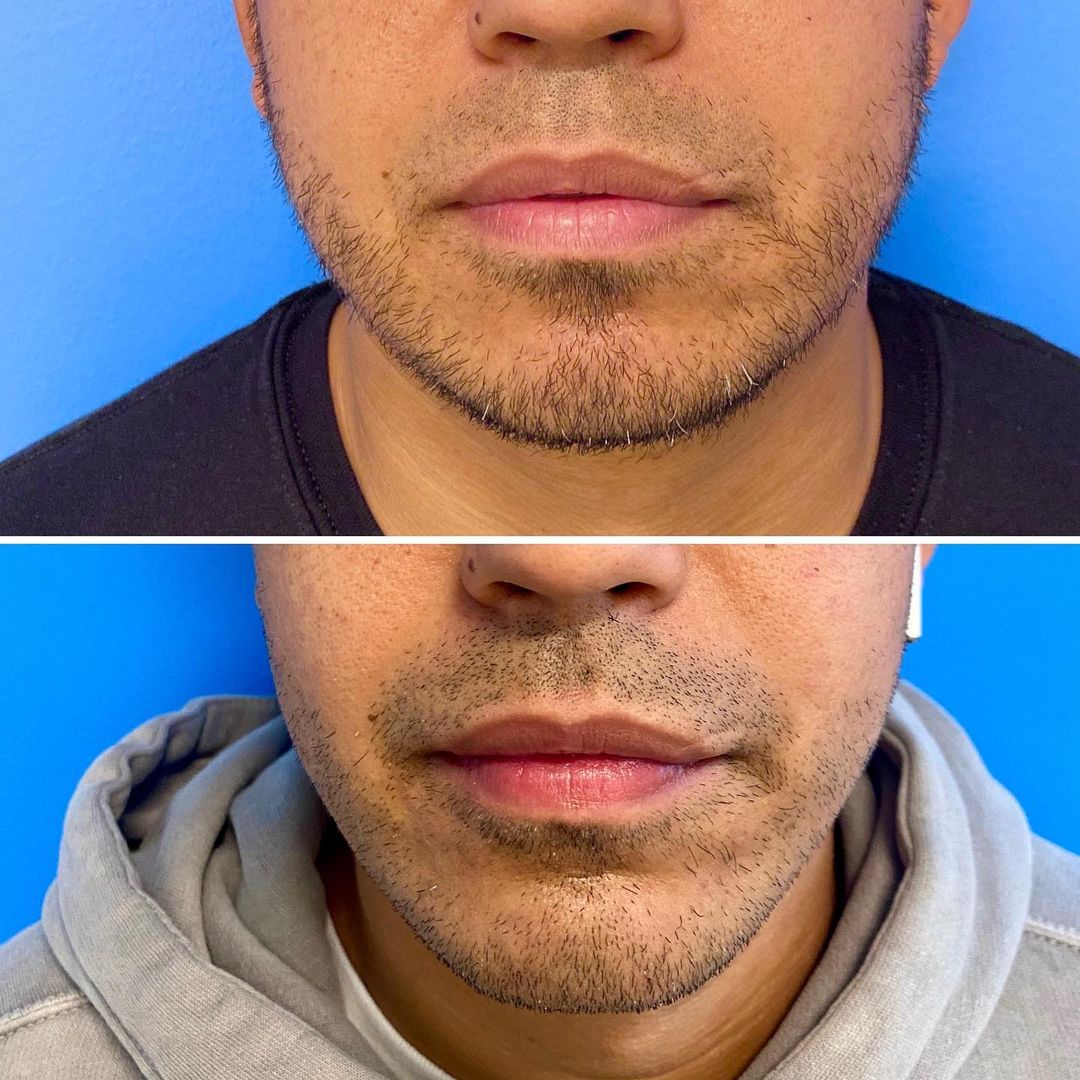 Lip Augmentation