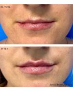 Lip Augmentation