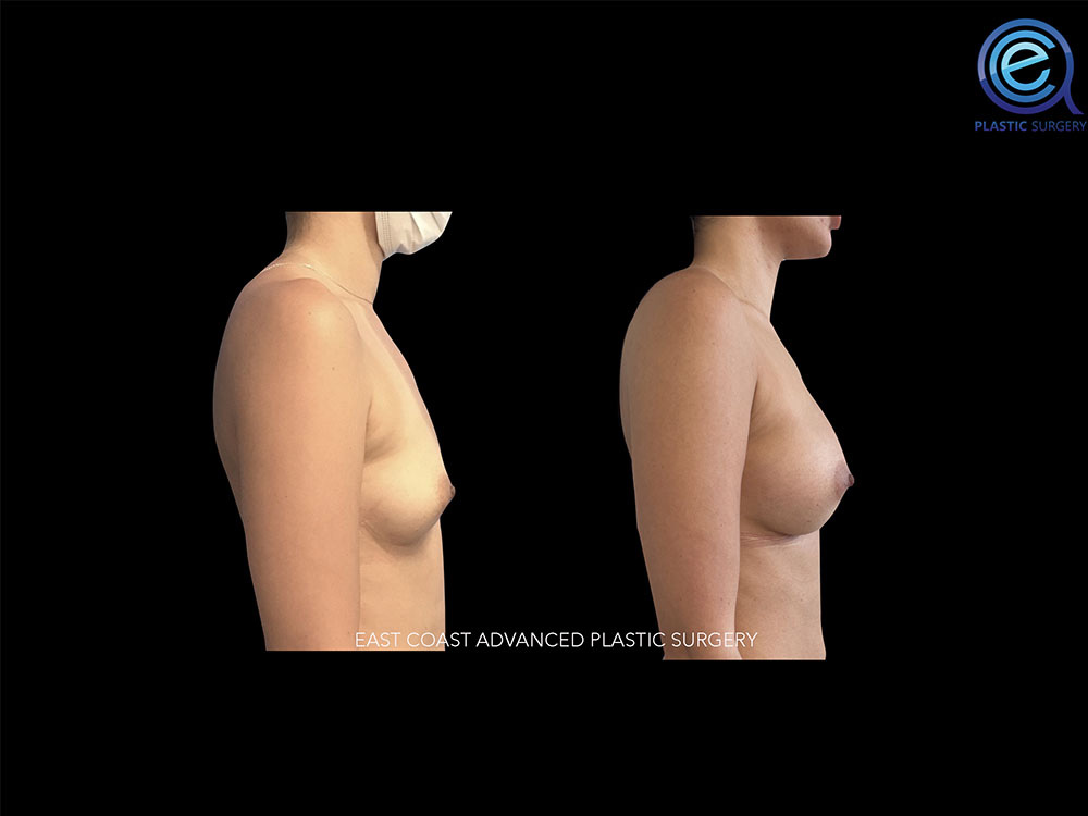 Real patient Breast Augmentation by ECA Plastic Surgery, New Jersey