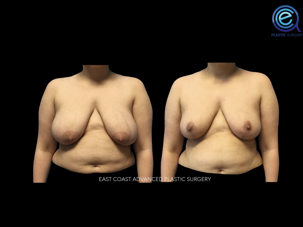 Real patient Breast Reconstruction by ECA Plastic Surgery, New Jersey